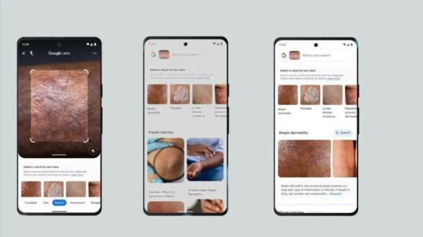 گوگل لنز اکنون می تواند بیماری های مختلف پوستی را تشخیص بدهد